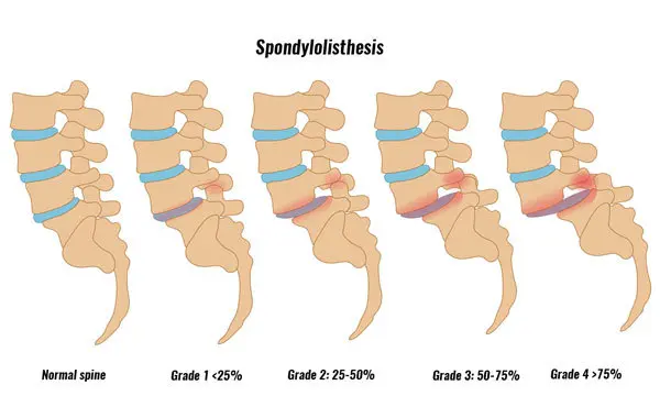 Spondylosis & Spondylolisthesis - Understanding and Optimsing Spinal Health