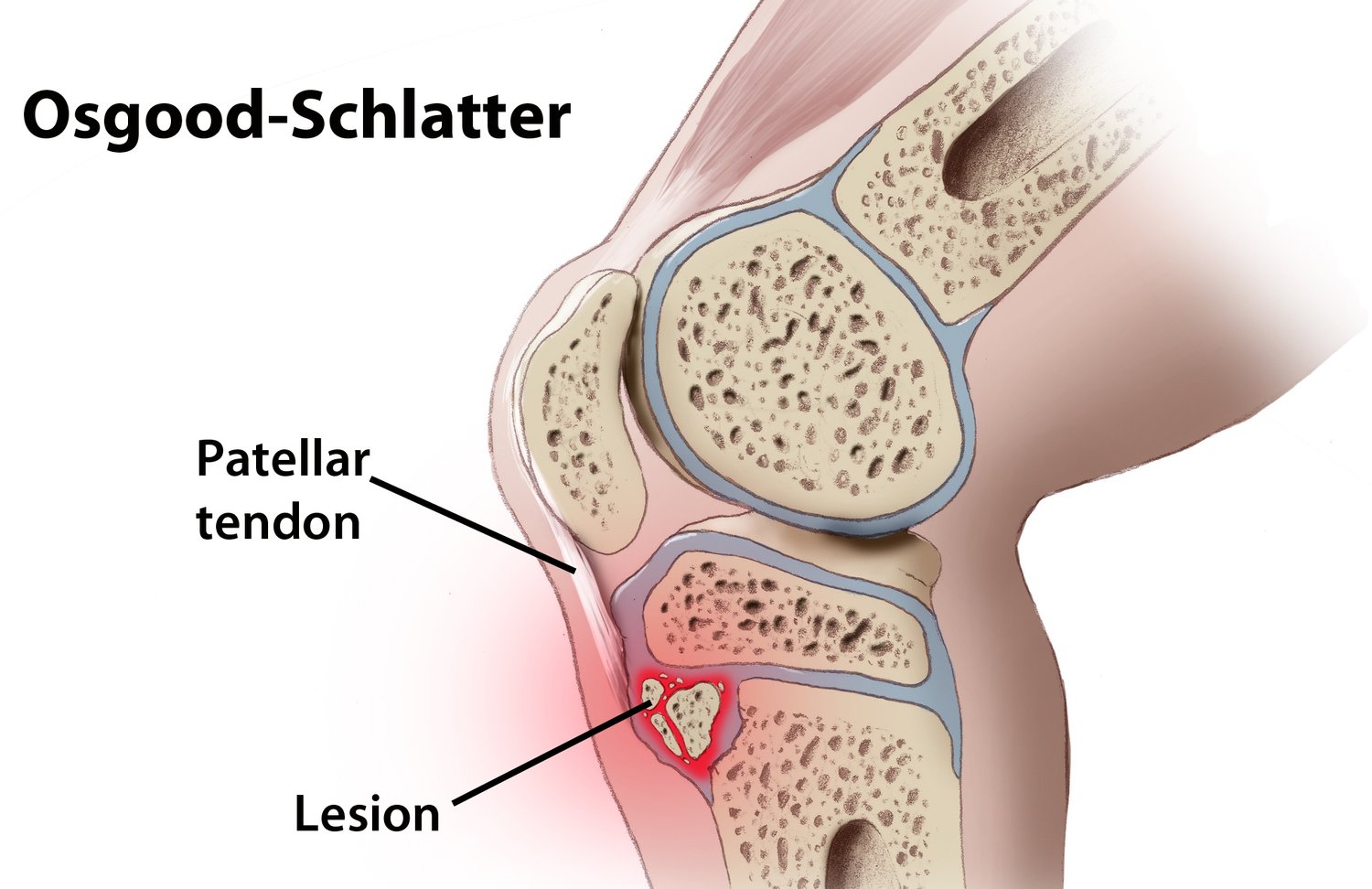 Osgood-Schlatter Disease - Management & Rehabilitation