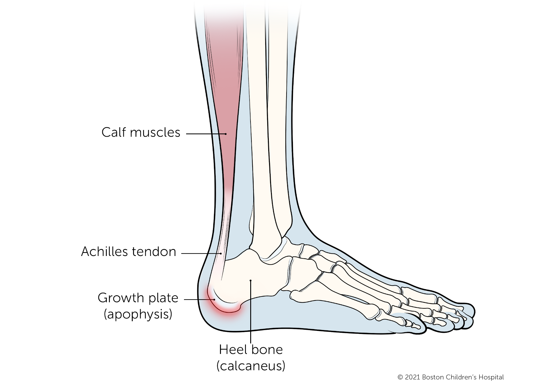 Sever's Disease - A Common Youth/Adolescent Injury