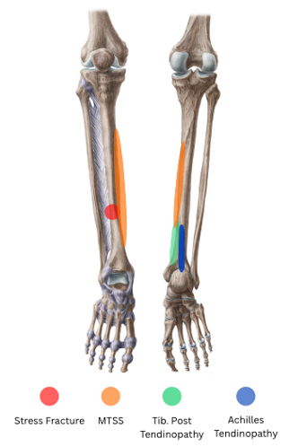 Medial Tibial Stress Syndrome - Beyond Shin Splints 