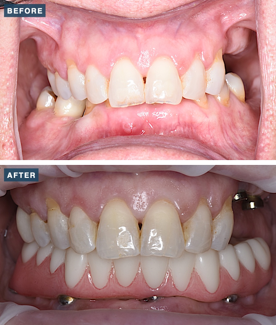 Before and after upper and lower dental implants at Legacy Dental Studio, serving Pittsburg, CA