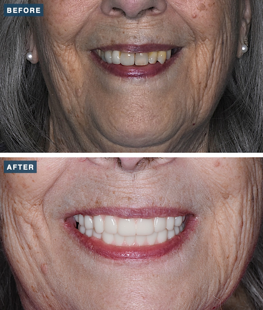 Before and after upper and lower All-on-X dental implants for an Oakley patient at Legacy Dental Studio