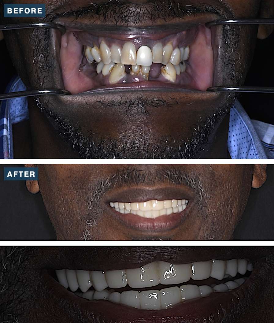Before and after upper and lower full-mouth All-on-X dental implants at Legacy Dental Studio, serving Pittsburg, CA