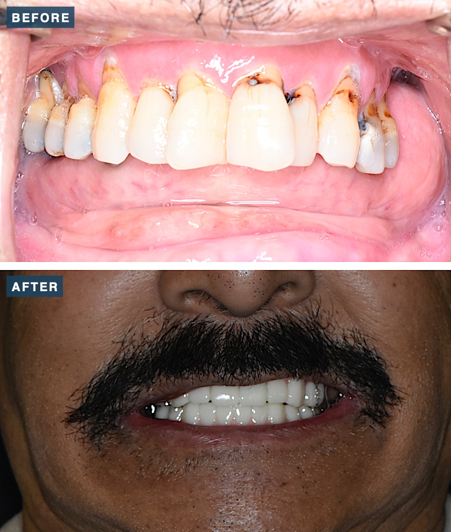 Before and after full-mouth All-on-X dental implants at Legacy Dental Studio, serving Pittsburg, CA
