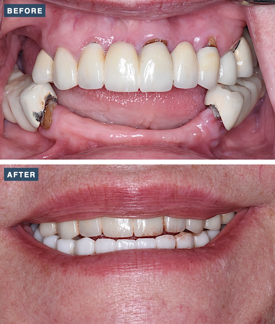 Before and after lower-arch All-on-X dental implants at Legacy Dental Studio, serving Brentwood, CA