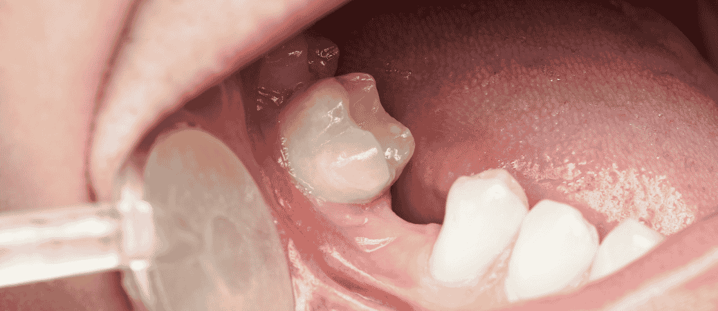 what-to-do-if-teeth-have-been-missing-for-years