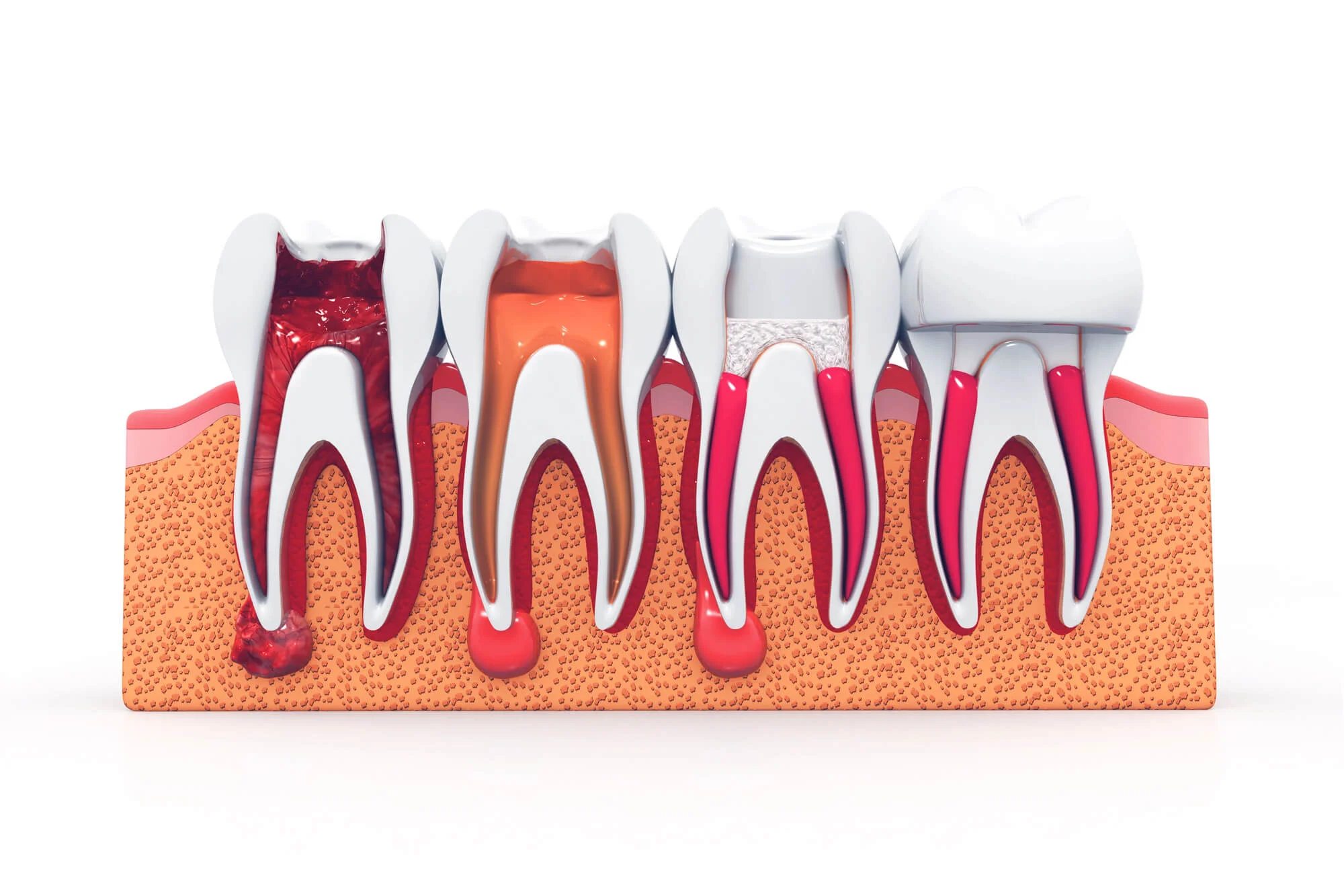 Diagram of infected tooth treatment dental emergency in Hueytown
