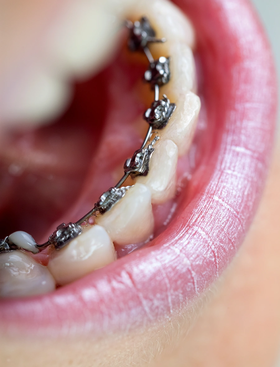 Close-up of teeth with metal braces attached to the inner side of lower teeth inside an open mouth.