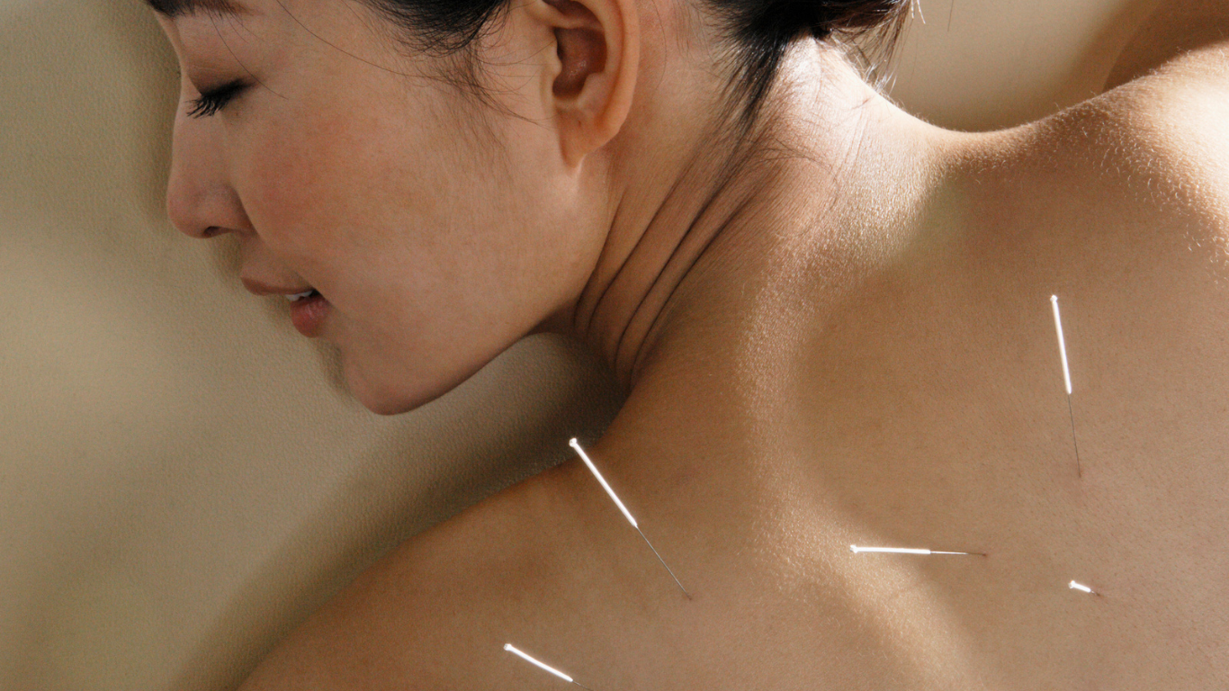 woman receiving acupuncture in back