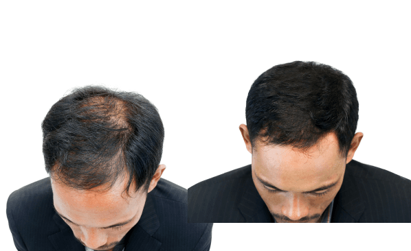 Patient using AM Rx for hair loss care online