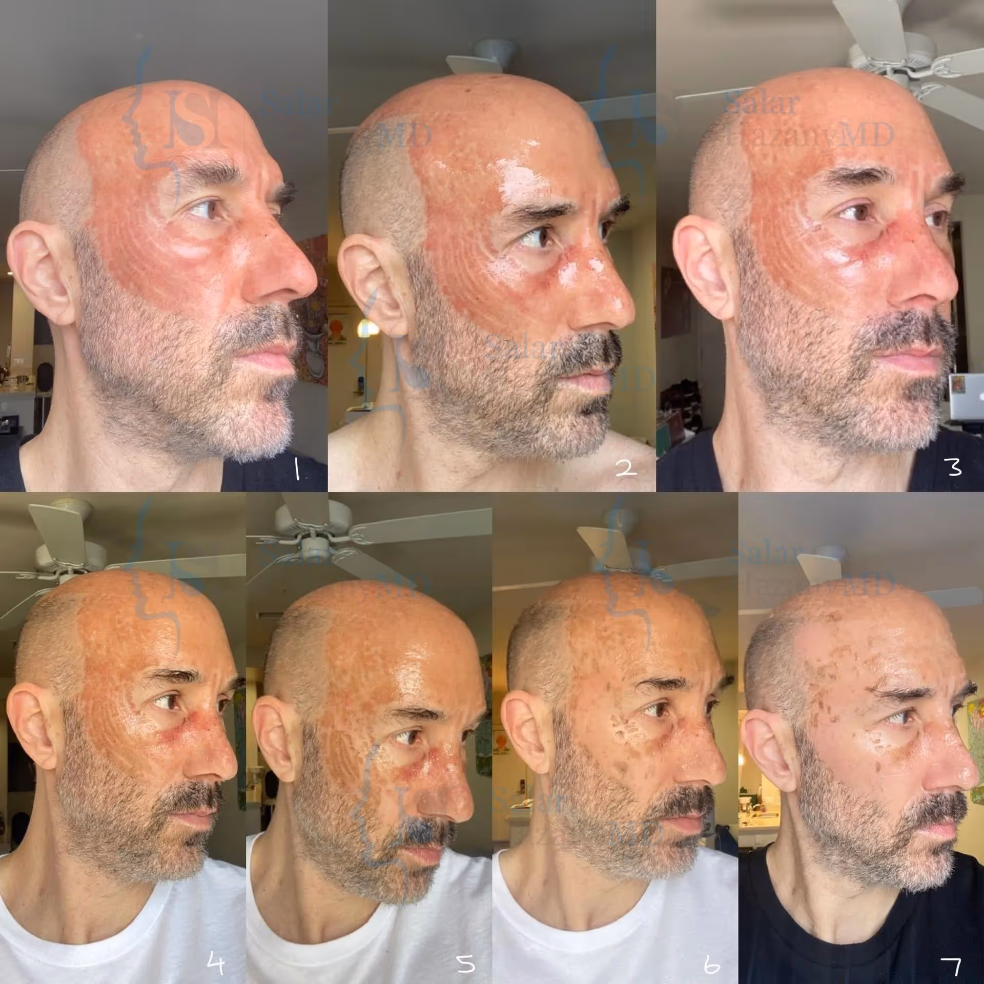 A bald man with a beard is shown in different angles