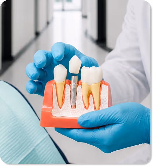 Dentist wearing blue gloves holding dental implant model showing real tooth, implant, and crown.