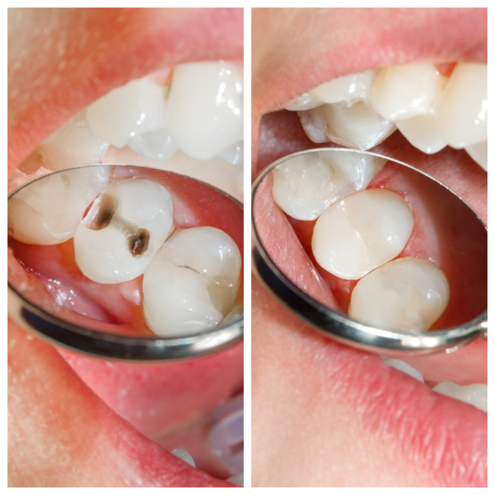 Dental 3D X-ray of jaw and teeth displayed on computer screen in a dental clinic.