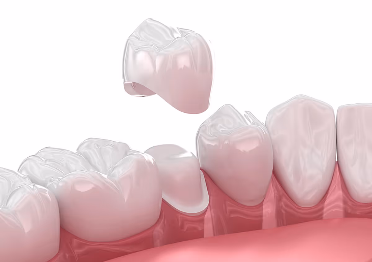 3D rendering of a dental crown being placed over a prepared tooth on the lower jaw.