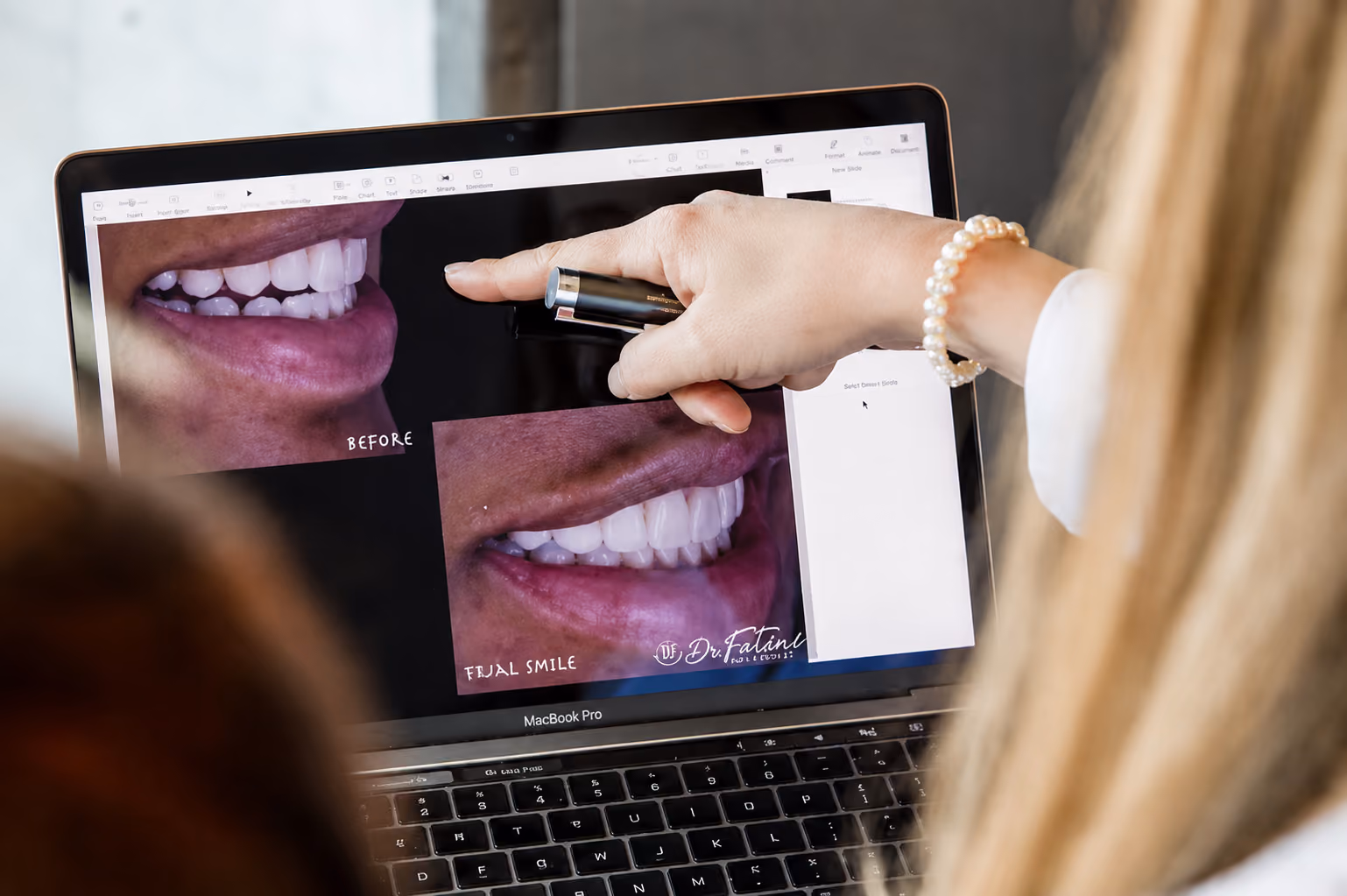 Person pointing at laptop screen showing before and after teeth whitening photos.