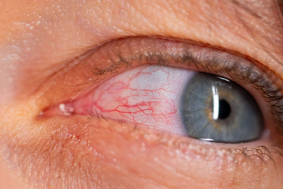 Are Your Artificial Tears Hurting Your Eyes?