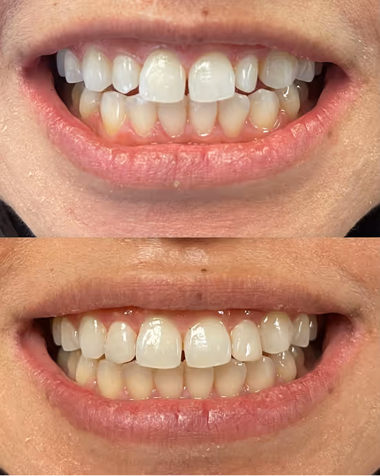 Before and after photos showing teeth gap closure and improved alignment in a person's smile.