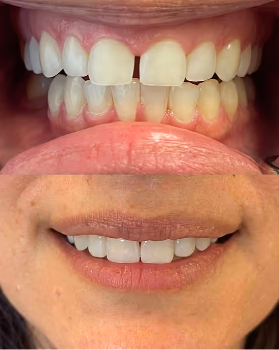Before and after close-up of a person's smile showing improved teeth alignment and whitening.