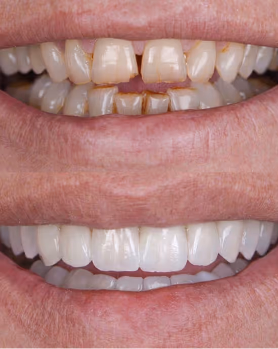 Before and after close-up of teeth showing stained, chipped teeth and after dental restoration.