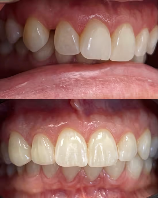 Before and after close-up of teeth showing improved alignment and spacing.