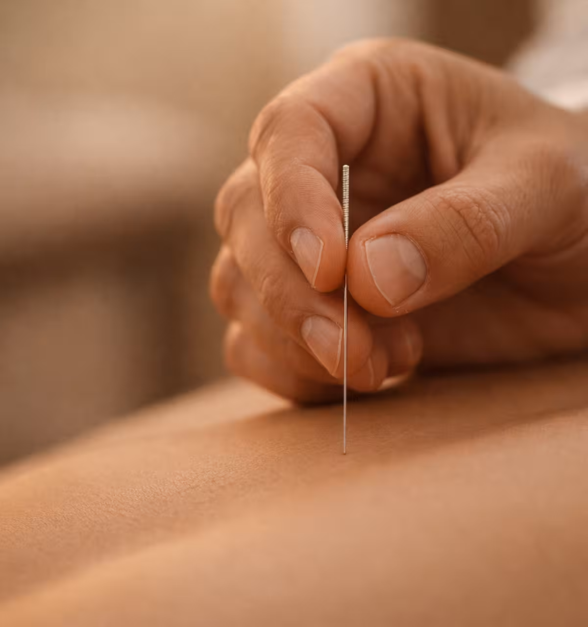 Hand holding an acupuncture needle inserted into a person's skin during treatment.