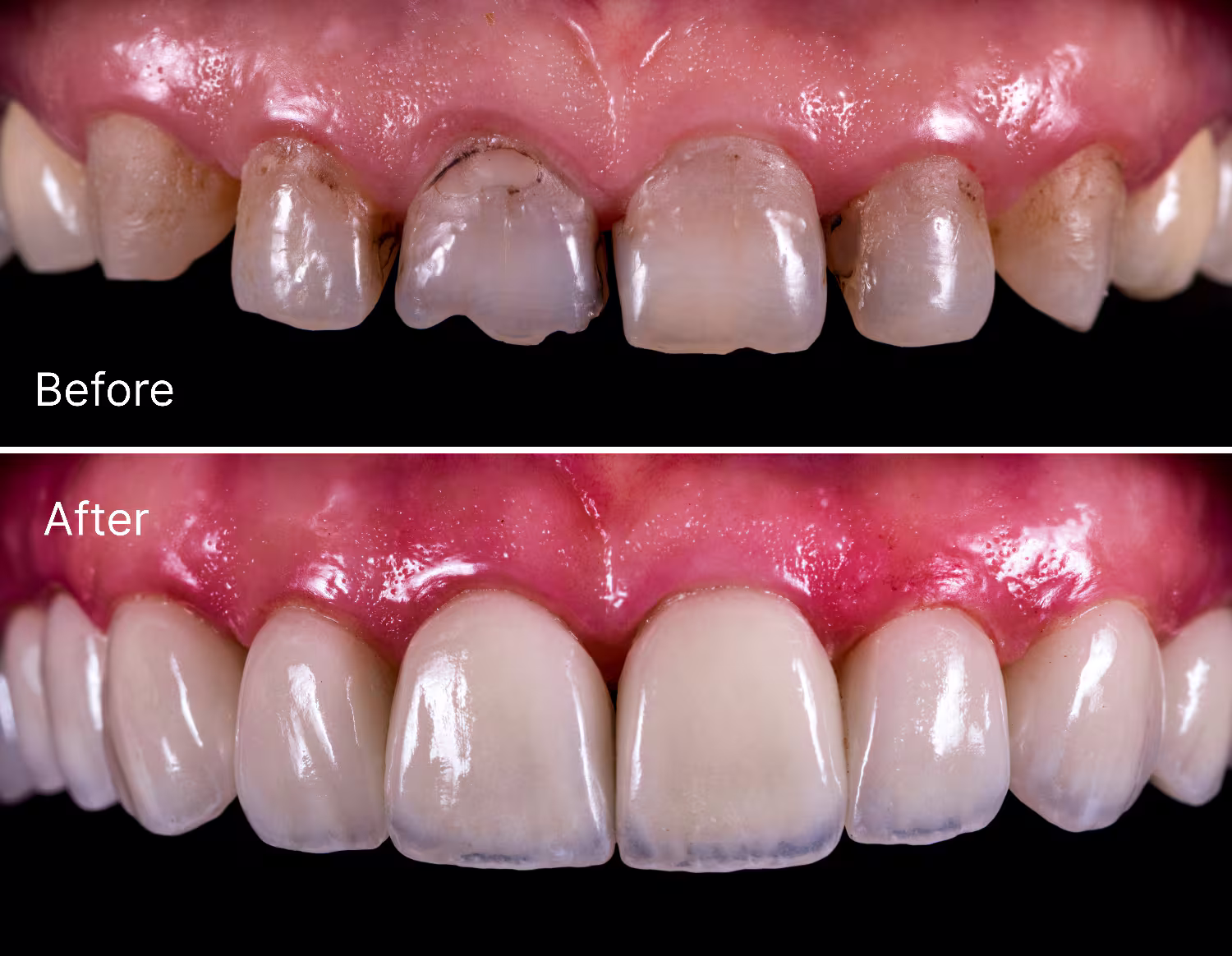 Esthetic Crowns for Children in Schertz, TX