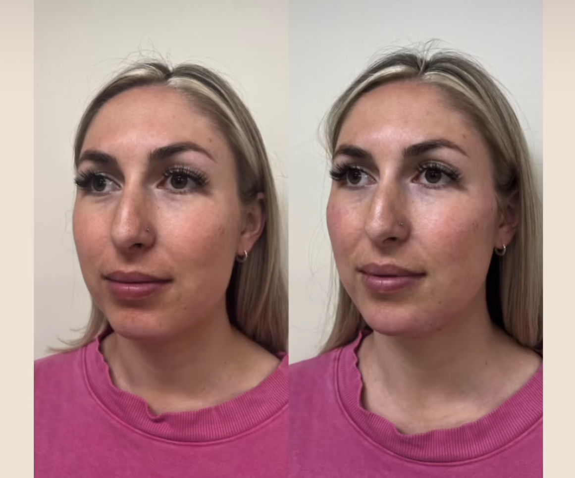Before and After Juvederm Voluma XC and Juvederm Volux