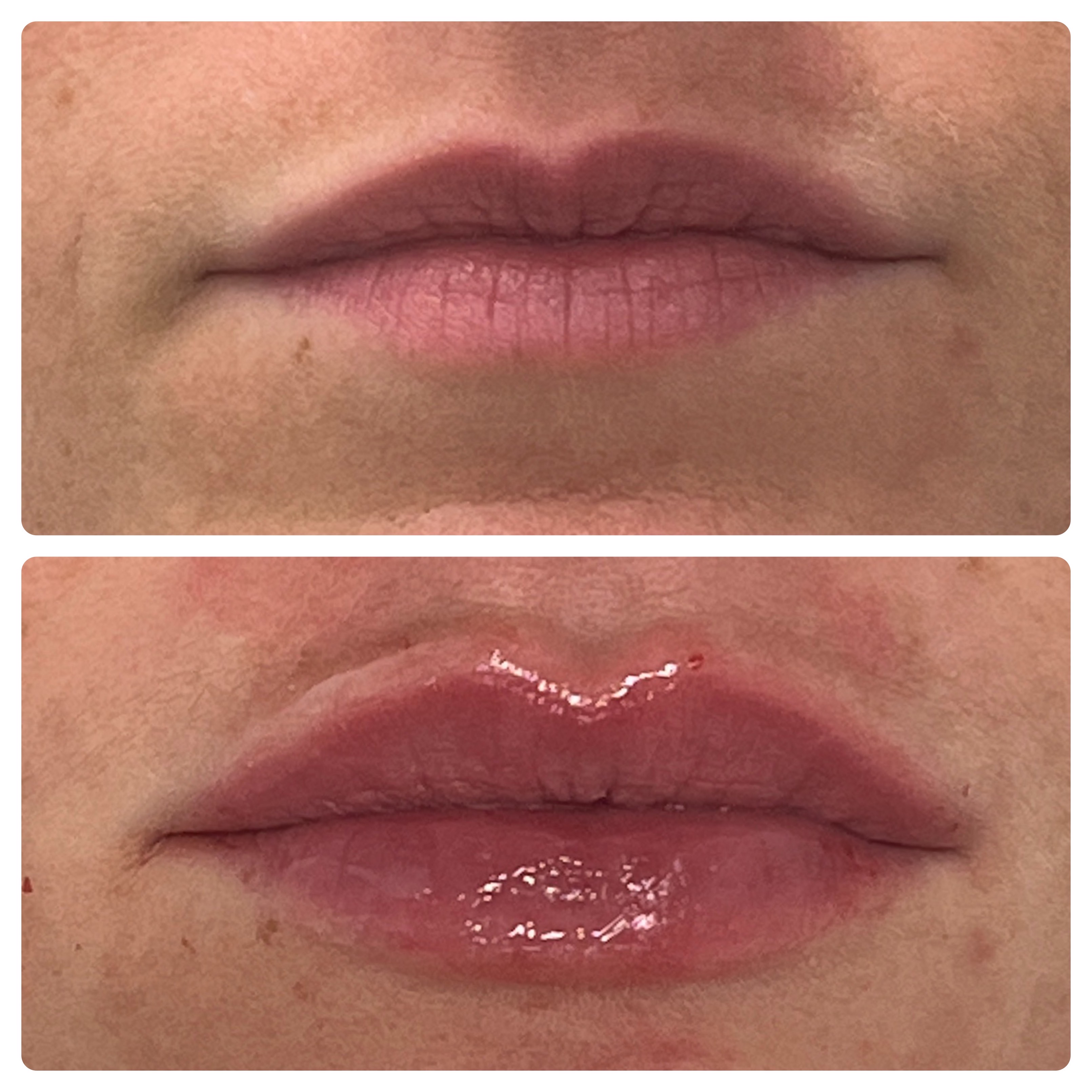 Before and After Lip Filler Juvederm Ultra XC