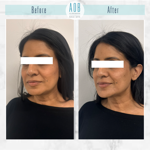 Botox & Juvederm Dermal Filler Before and After