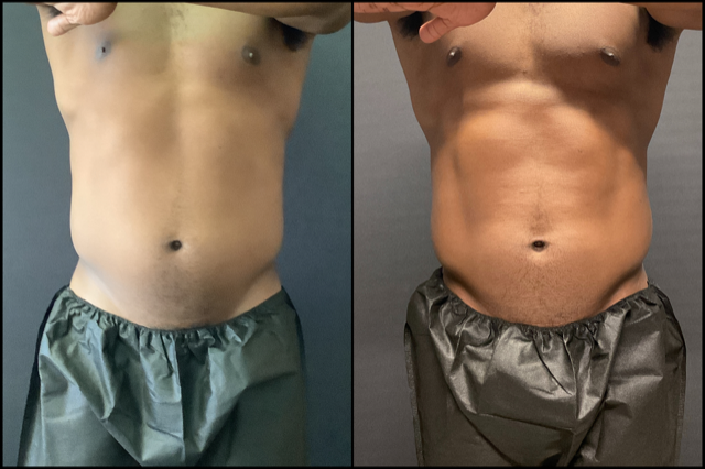 CoolSculpting Before and After Male Abdomen and Flanks