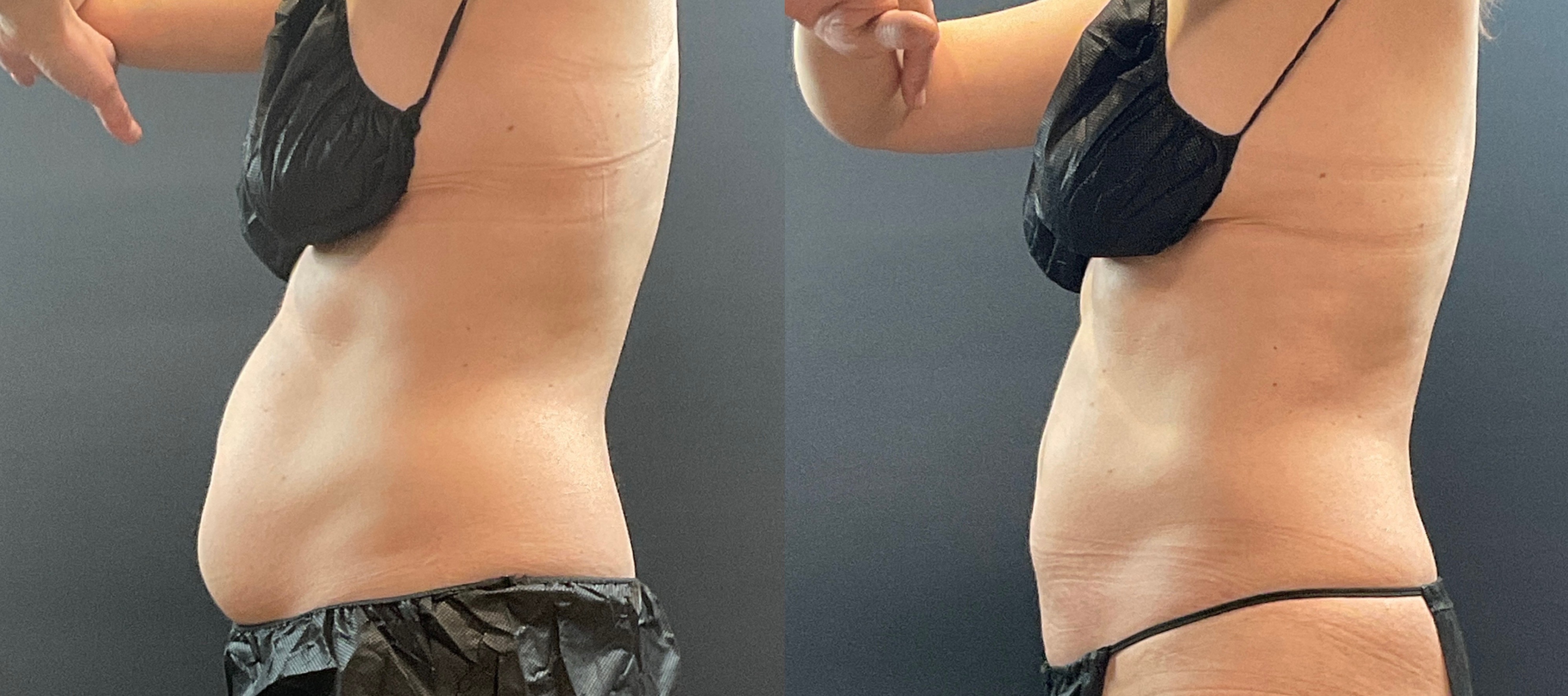 Coolsculpting - Before and After Female Abdomen