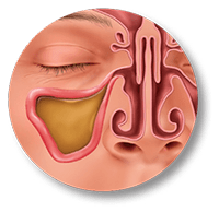 Balloon Sinuplasty Procedure Locate