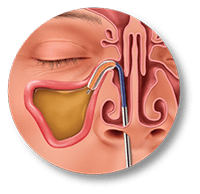Balloon Sinuplasty Procedure Dilate