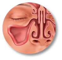 Balloon Sinuplasty Procedure Relieve