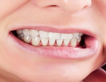 What Causes Nocturnal Bruxism? 