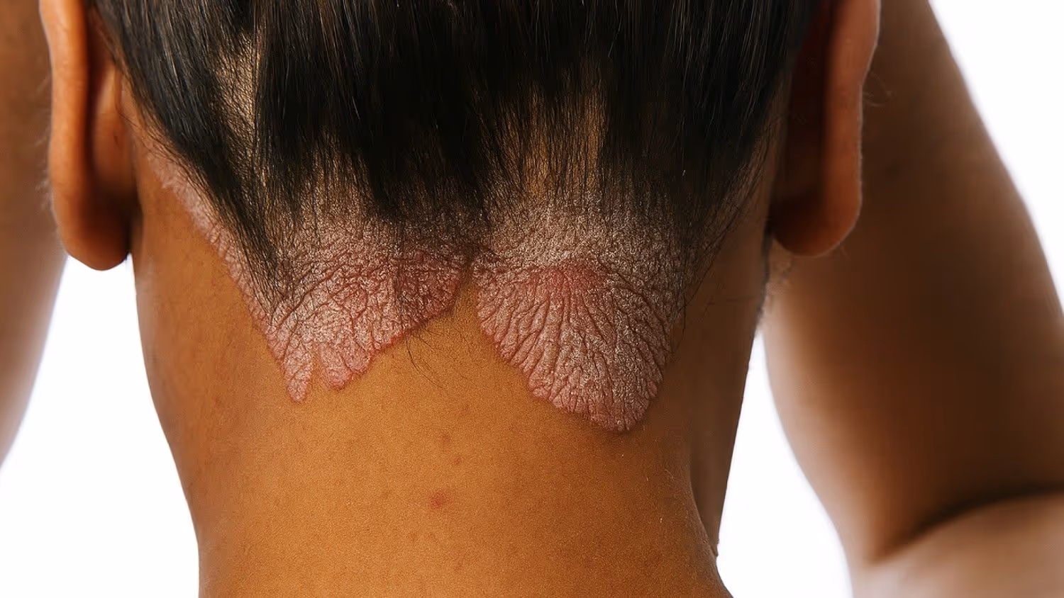 Scalp Psoriasis