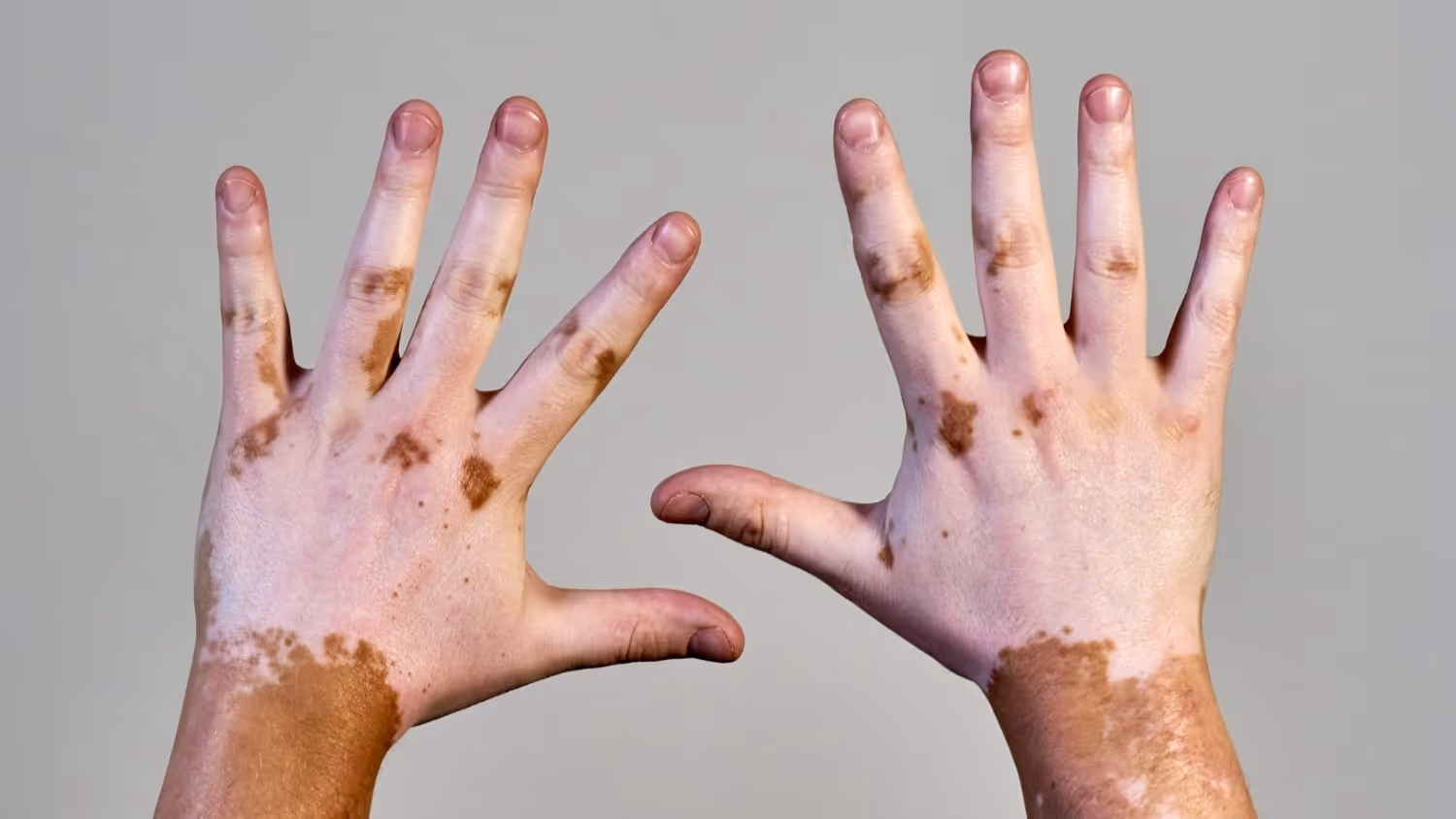 Causes and Risk Factors of Vitiligo