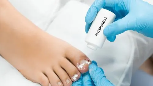 Prevention Strategies to Avoid Recurrence of Fungal Infections