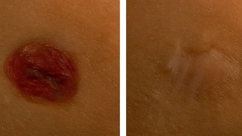 Potential for Scarring