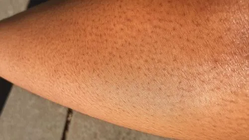 What Is Strawberry Skin?