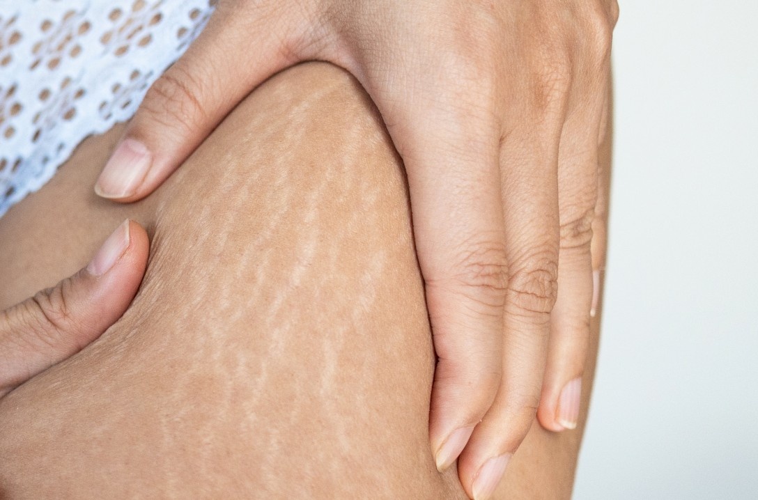 Expert Laser Care in Chennai for Stretch Mark Reduction