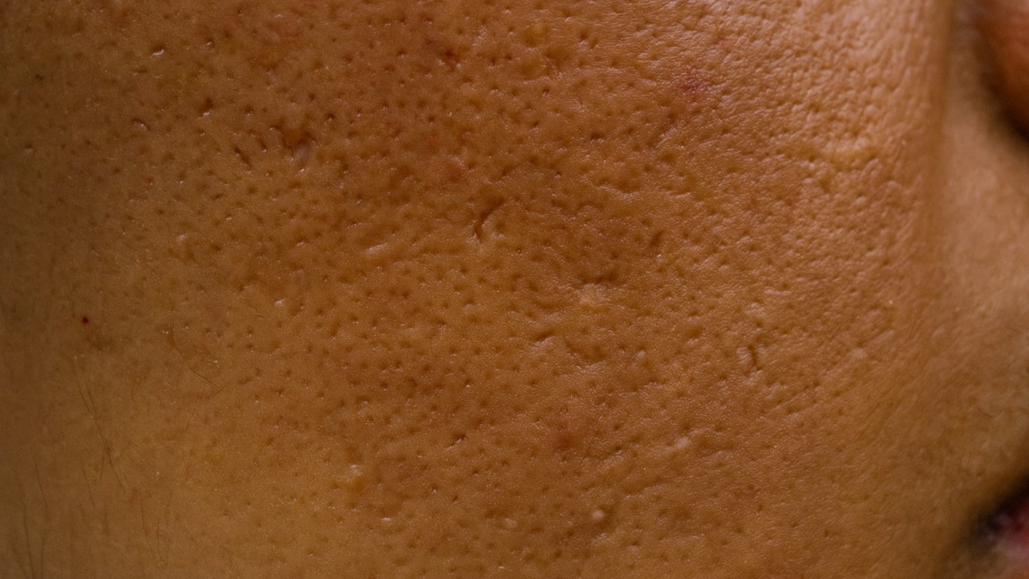 Ice Pick Scars