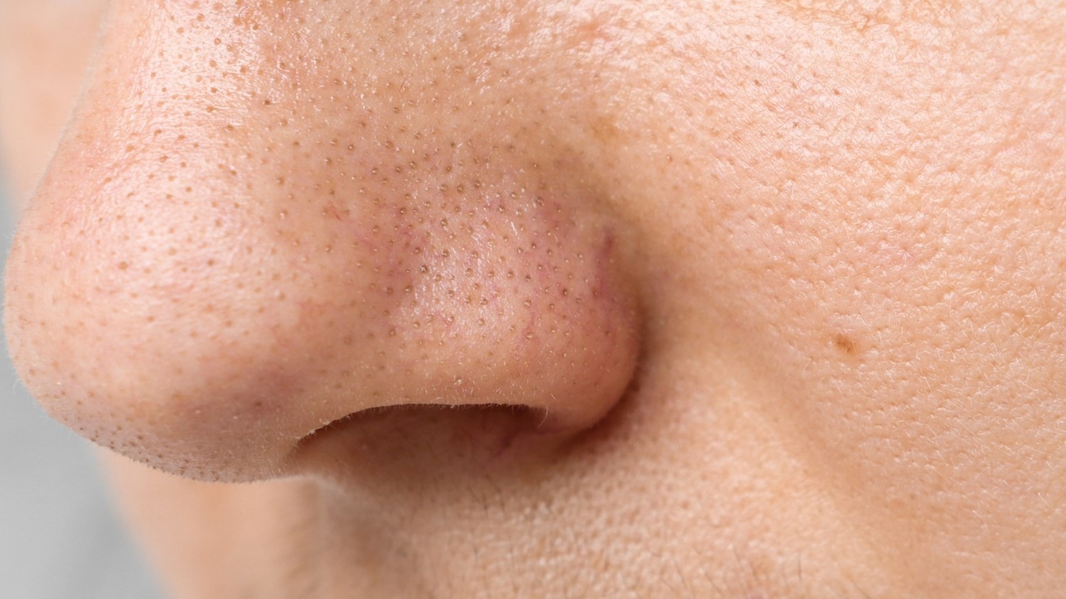Enlarged Pores