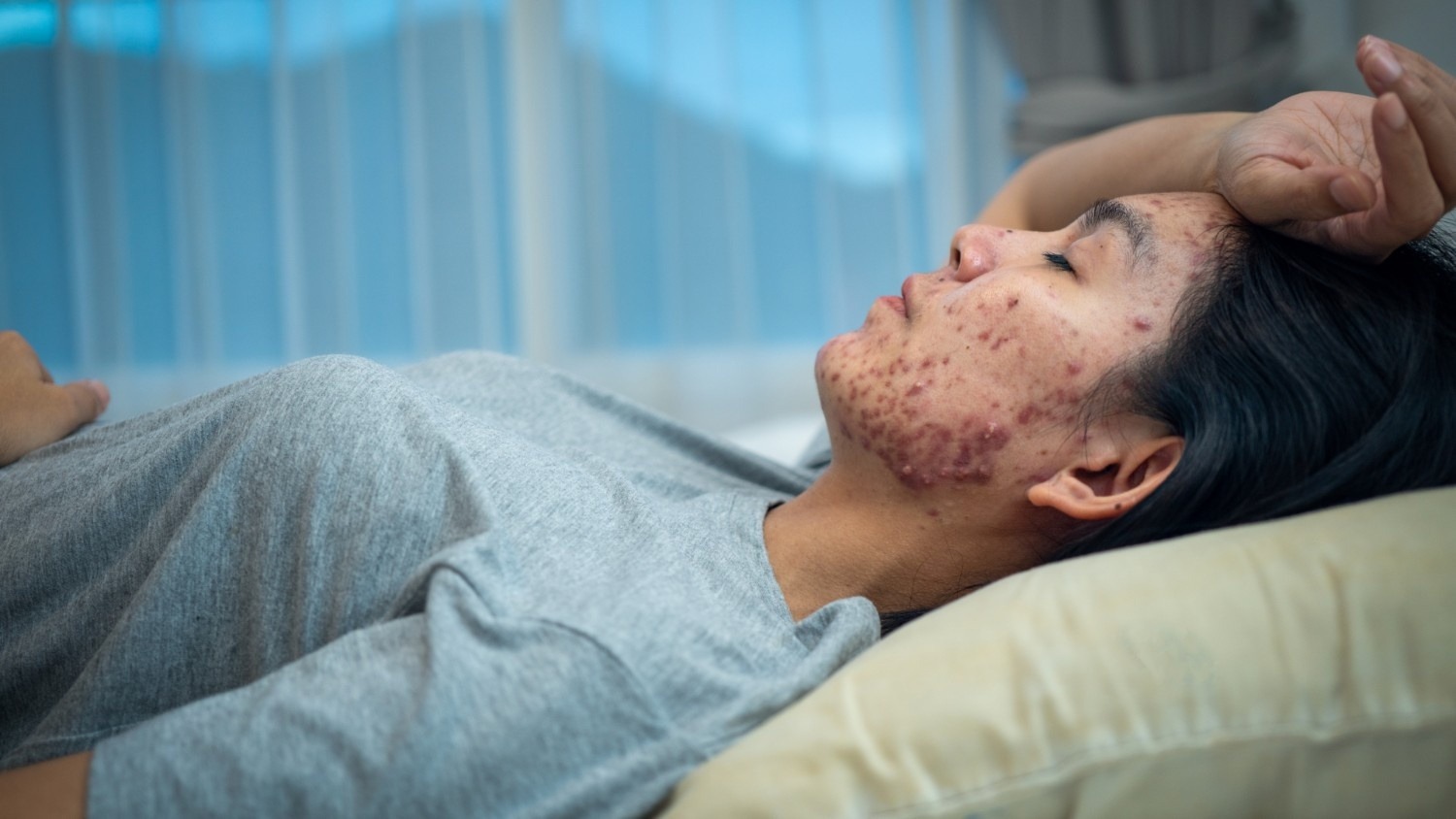 Acne Scars