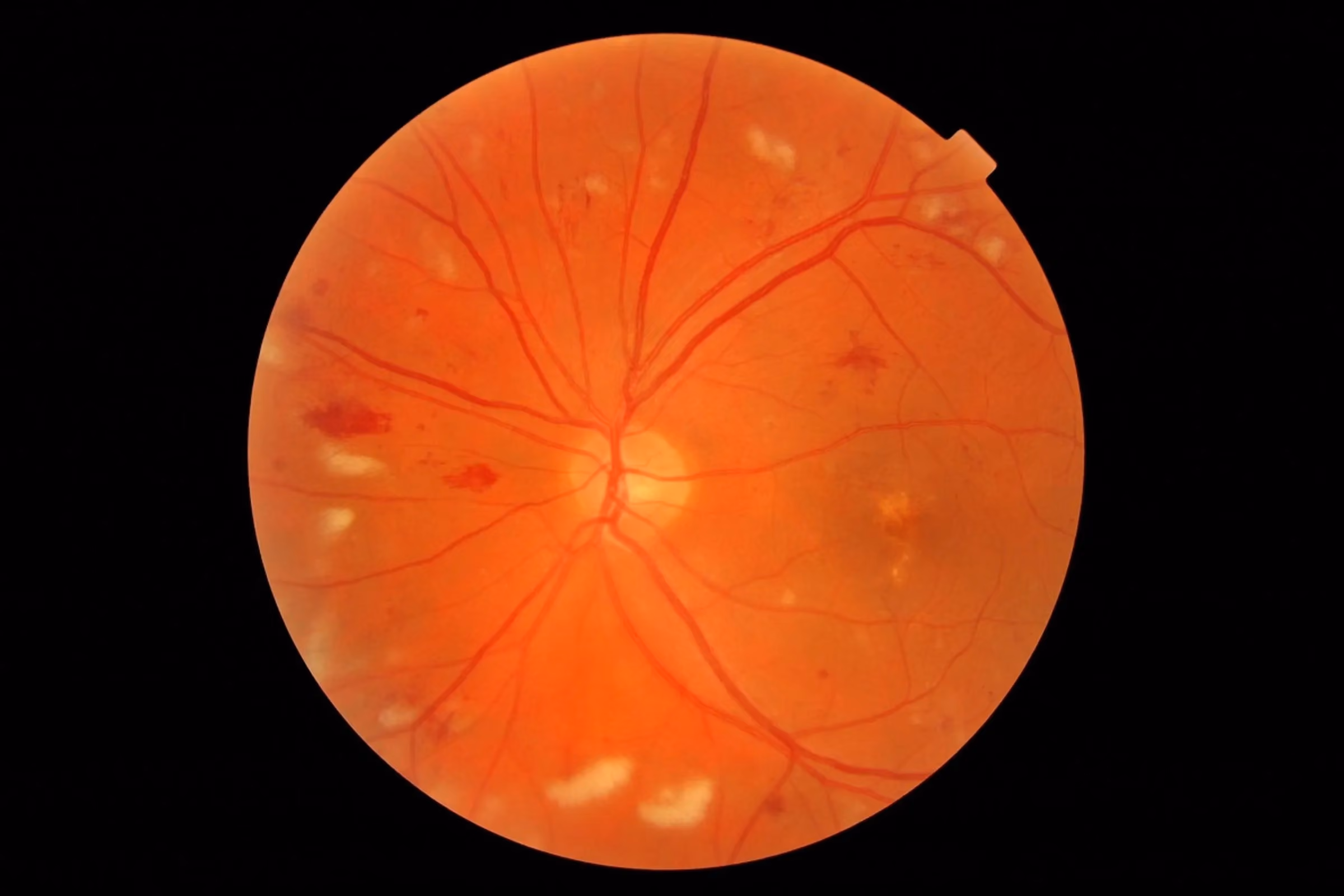 Glaucoma