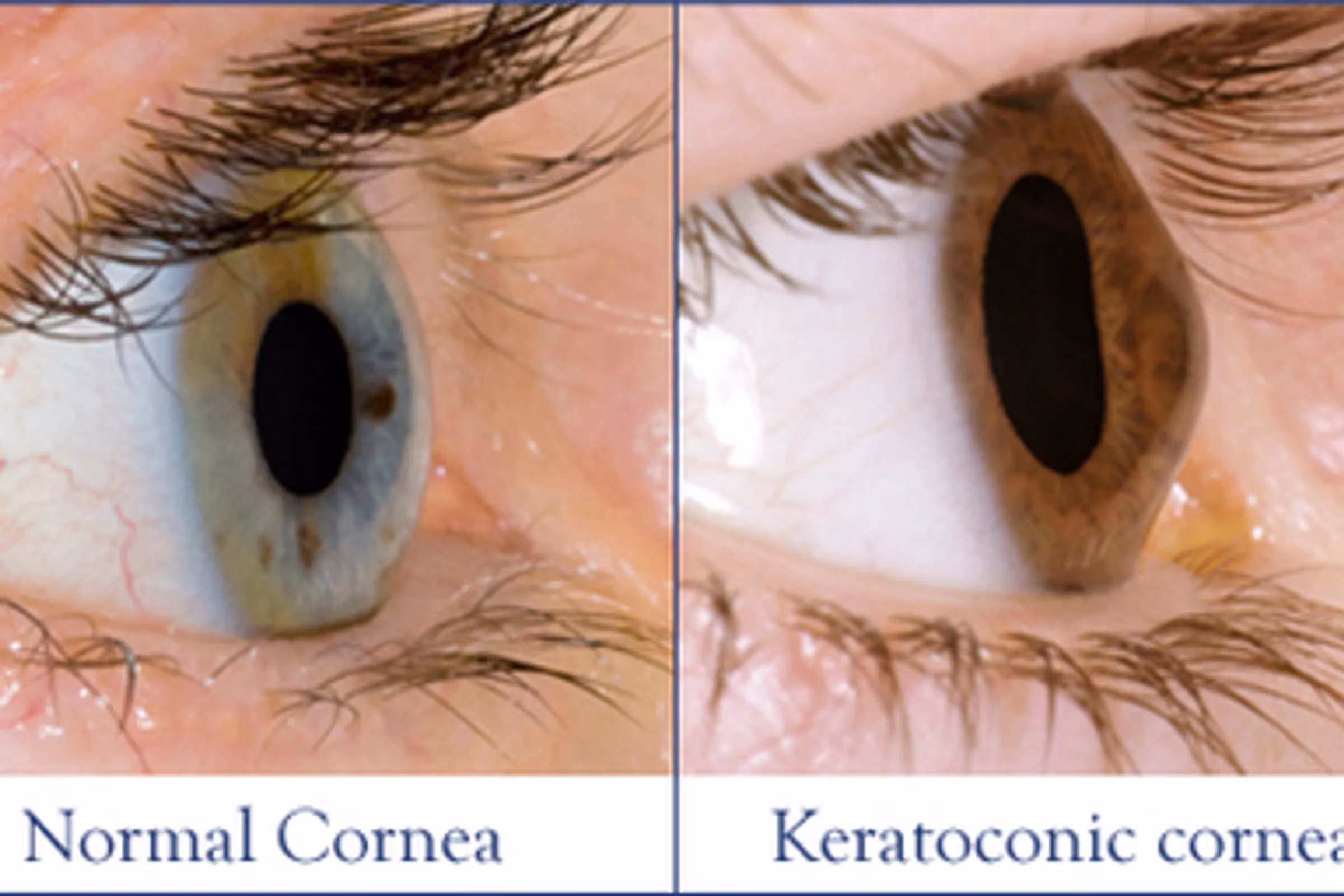 Keratoconus