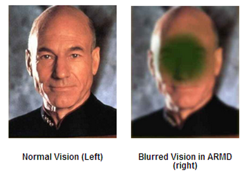 Simulation of vision with central area affected by macular degeneration