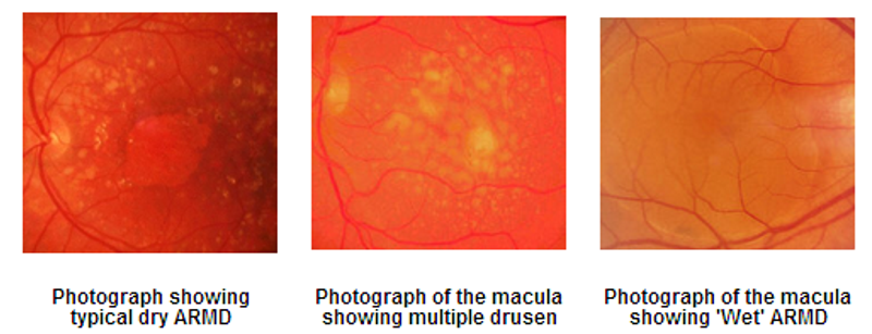 Diagram showing wet age-related macular degeneration with abnormal blood vessels under the macula