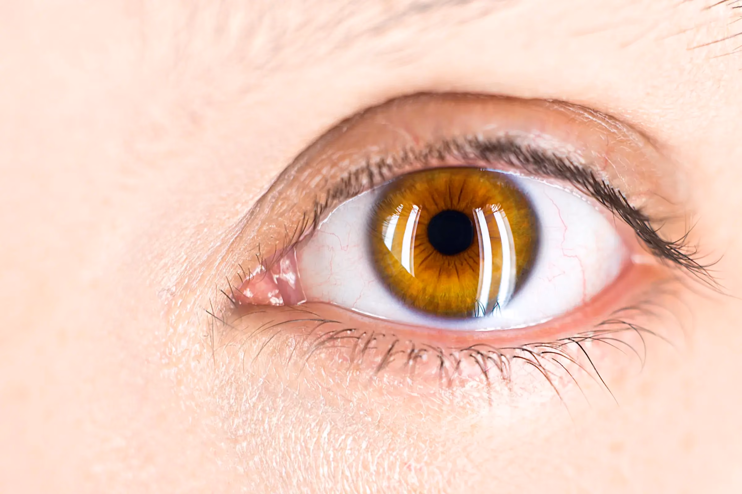 Cataracts