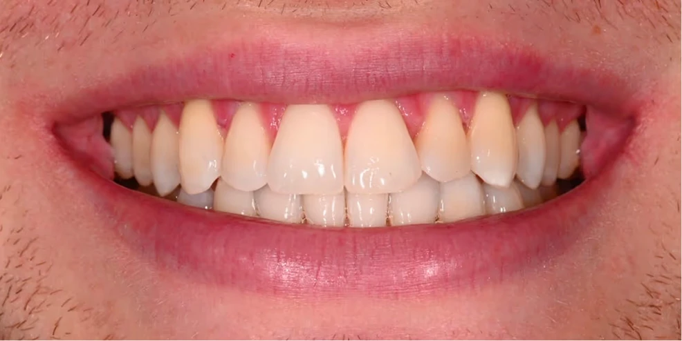 Risultato prima e dopo un trattamento estetico dentale